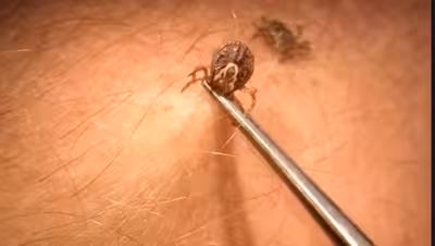 Maladie De Lyme : Montréal atteint 161 cas, un sommet en 23 ans