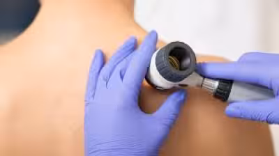 Melanoma cases in the UK pass 20,000 as heat alert hits England