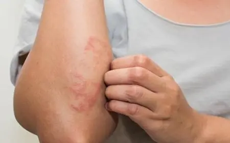 جل الصبار الأبرز.. 4 علاجات منزلية فعالة للأكزيما