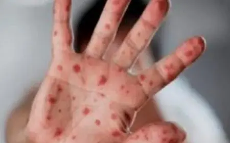 جدري القرود يتسبب في وفاة أكثر من 400 شخص ويثير قلق السلطات بالكونغو الديمقراطية