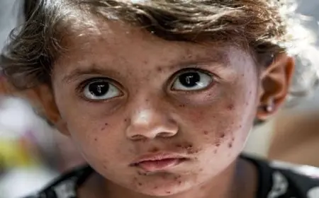 أوبئة جلدية “غربية” تضرب مخيمات النازحين في غزة