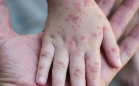 الصحة العالمية: جدري القرود ليس كوفيد-19 جديد