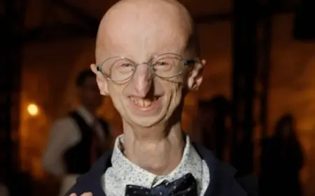 وفاة المصاب بالشيخوخة المبكرة الأطول عمرا عن 28 عاما