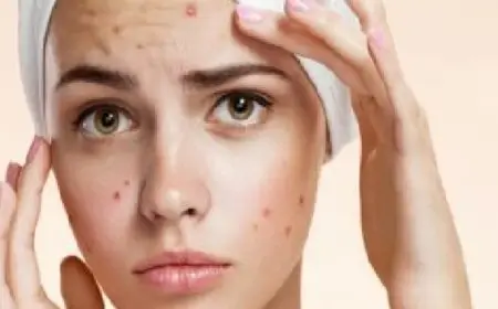 وصفات طبيعية لعلاج ندبات حب الشباب.. للحصول على بشرة جذابة