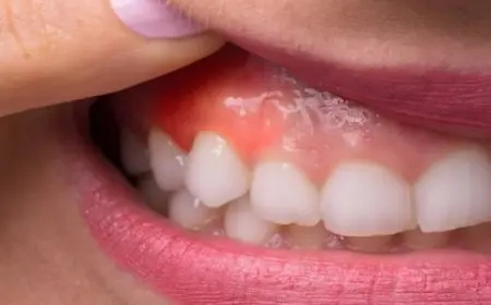 رائحة الفم الكريهة والتورم أهم أعراض التهاب اللثة