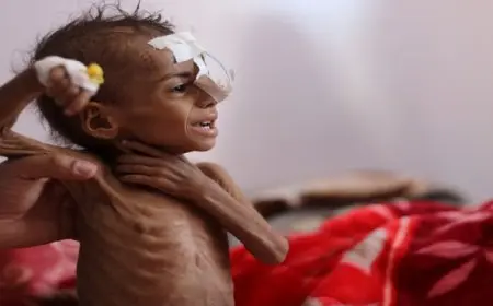 الأمم المتحدة: أكثر من 17 مليون شخص فى اليمن يعانون من الجوع