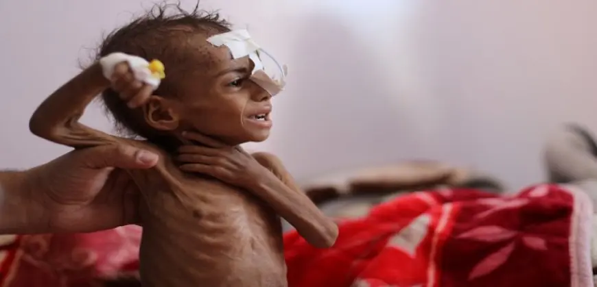 الأمم المتحدة: أكثر من 17 مليون شخص فى اليمن يعانون من الجوع