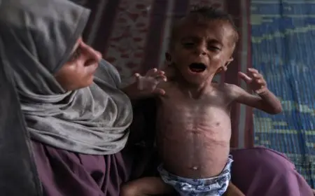 مصادر طبية في غزة تكشف عن 11 حالة وفاة بينهم طفلان نتيجة المجاعة وسوء التغذية خلال يوم واحد