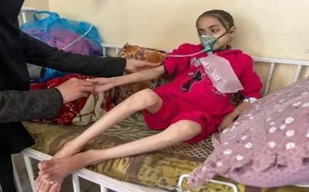 استشهاد ثلاثة فلسطينيين جراء المجاعة وسوء التغذية في قطاع غزة