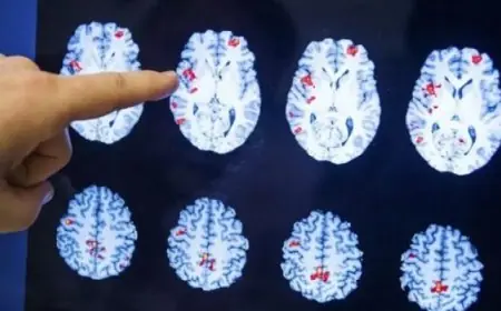 أزمة صامتة تتفاقم في أمريكا مع تزايد ملحوظ في حالات الإعاقات الإدراكية