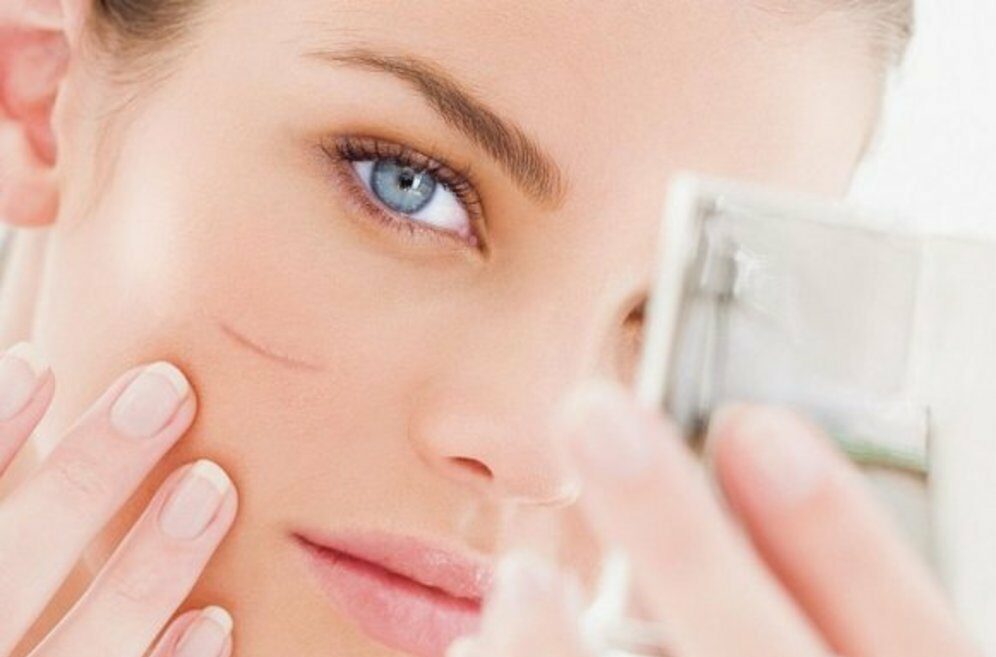 علاج الجروح والخدوش في الوجه باستخدام 9 وصفات طبيعية أو عملية الليزر لمعالجة الندبات