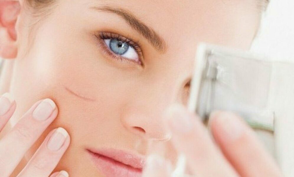 علاج الجروح والخدوش في الوجه باستخدام 9 وصفات طبيعية أو عملية الليزر لمعالجة الندبات