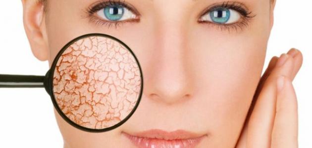 كيفية علاج جفاف الوجه الحساس ونصائح للحفاظ على البشرة