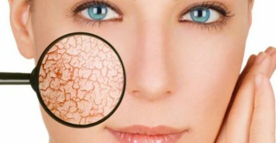 كيفية علاج جفاف الوجه الحساس ونصائح للحفاظ على البشرة