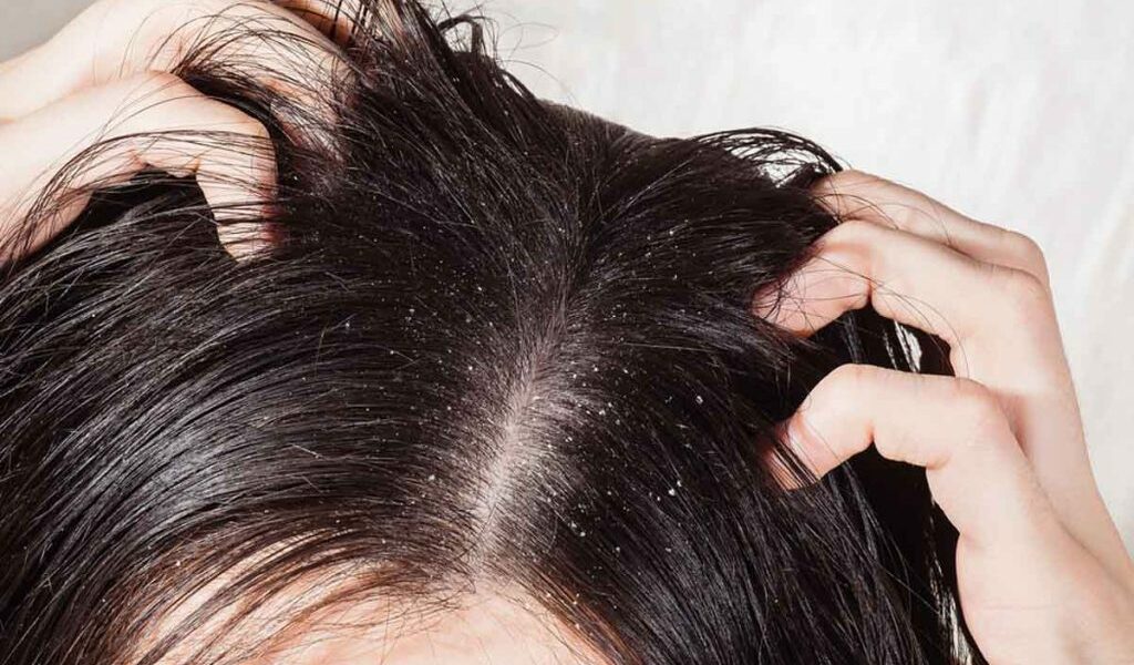 أفضل 8 وصفات للتخلص من قشرة الشعر بالخل