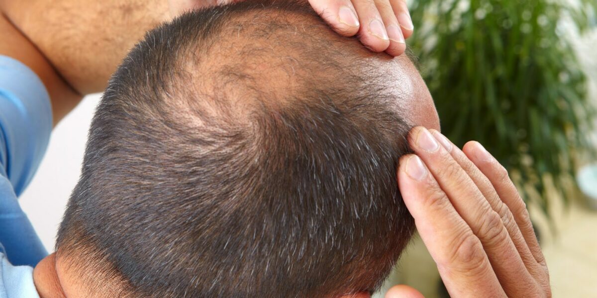 علاج تساقط الشعر عند الرجال بوصفات الطبيعية