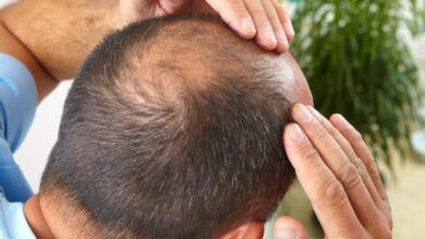 علاج تساقط الشعر عند الرجال بوصفات الطبيعية