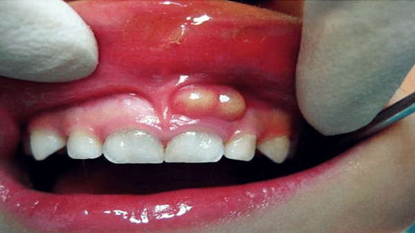 الفرق بين خراج اللثة خراج الأسنان