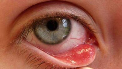 Photo of طرق علاج الكيس الدهني في العين بالثوم