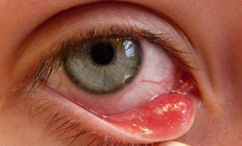 علاج الكيس الدهني في العين بالثوم