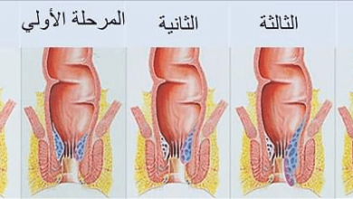 Photo of أعراض البواسير عند الرجال