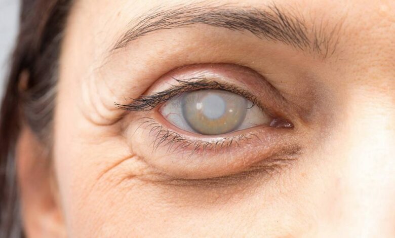 أعراض الماء الأبيض في العين المبكرة