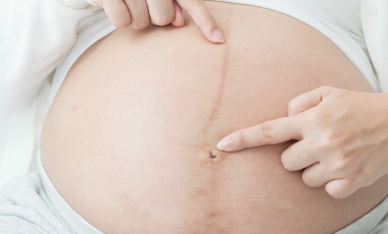 شكل خط البطن أثناء الحمل بولد