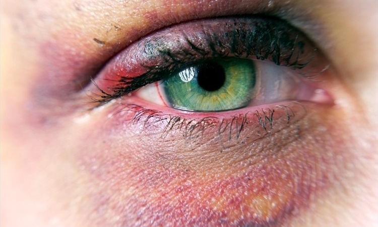 علاج تورم العين بسبب ضربة