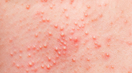 علاج حساسية الجلد من الحرارة