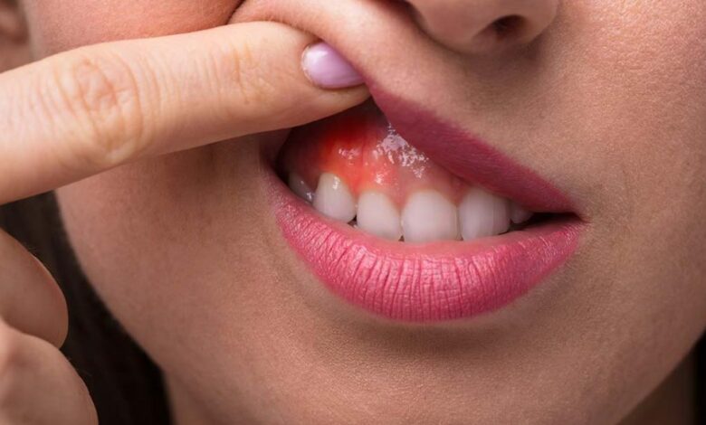 علاج خراج الأسنان بالمضاد الحيوي