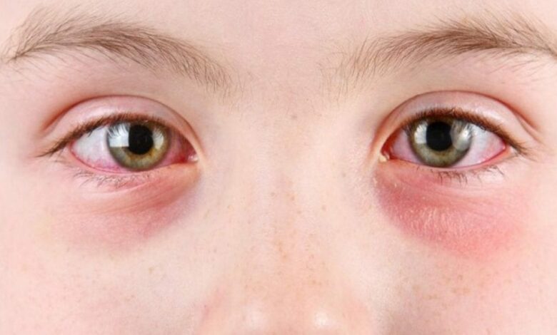 ما هي أسباب كثرة رمش العين عند الأطفال 